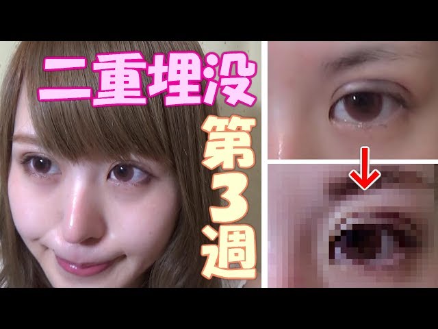 Double eyelid surgery progress summary (15th to 21st days) - YouTube