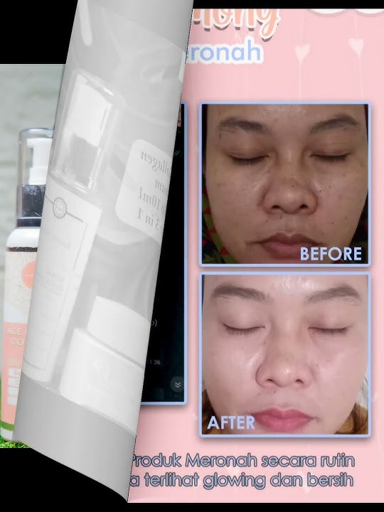 Yang punya keluhan wajah flek bisa banget pake paket platinum dari meronah😍