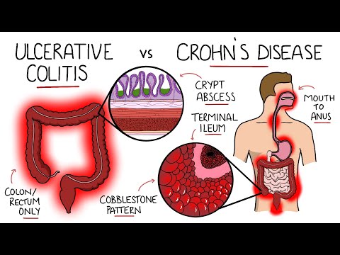 Inflammatory Bowel Disease - Ulcerative Colitis v Crohn&rsquo;s Disease (With Histology & Manifestations)