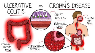 Inflammatory Bowel Disease  Ulcerative Colitis v Crohn's Disease (With Histology & Manifestations)
