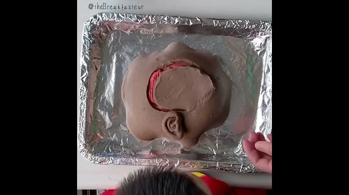 Playdough Surgery - Craniotomy and Meningioma (Brain Tumor) Removal - DayDayNews