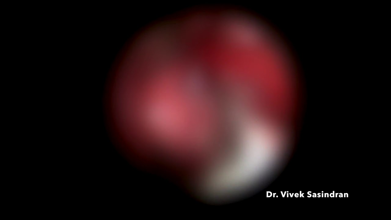 Endoscopic DCR in post left carcinoma maxilla excision