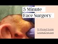 Large Face cyst comes out like butter! Dr Khaled Sadek. LipomaCyst.com