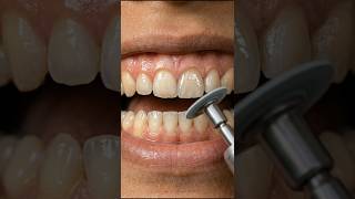 You won't believe how this tooth got fixed... 😱