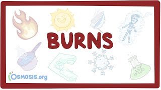 Burns - An Osmosis Preview