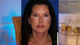 Facelift Testimonial Lynn s Story Dr Sang Kim Natural Face Clinic