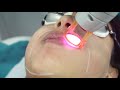 Laser hair removal for face