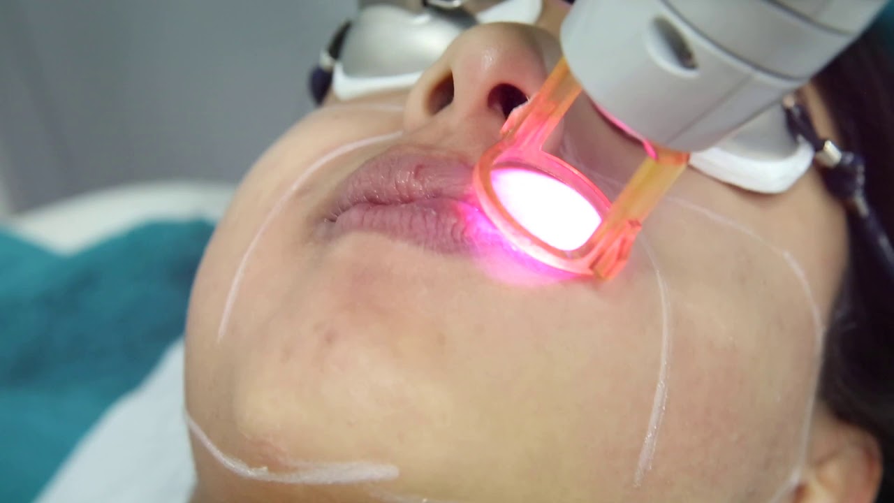 Laser hair removal for face