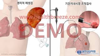 [시연용] a0169aako_[대한내과학회] 폐암