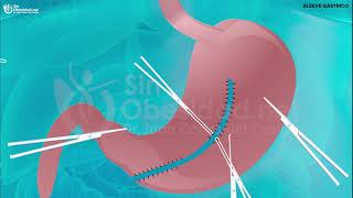 Cirugía bariátrica: Sleeve gástrico