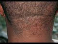 Aloe vera for Razor bumps/Clipper bumps/pimples and more