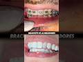 Ortodoncia #dentista #bracket #dentist #braces #ortodoncia #brackets #orthodontics #orthodontist