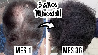 36 Meses Usando MINOXIDIL en el CUERO CABELLUDO ¡RESULTADOS! | Tratamiento Caida de CABELLO
