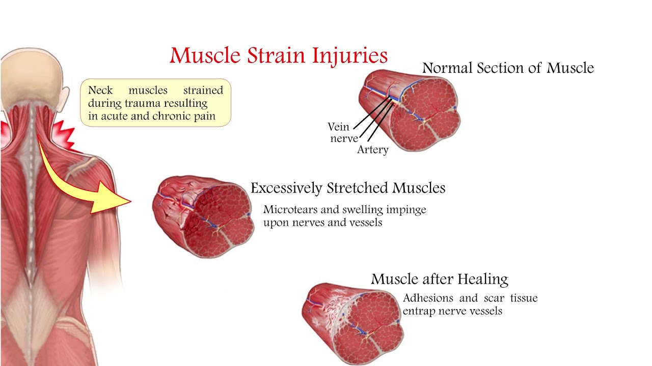 MUSCLE PULL YouTube MUSCLE PULL YouTube