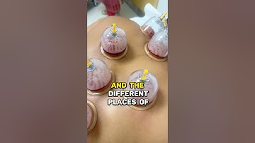 REVITALIZE your body and mind with our new HIJAMA THERAPY service! 🙌 #hijamatherapy #dubaiwellness