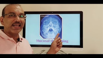 X ray sinuses (English) Patient teaching programme