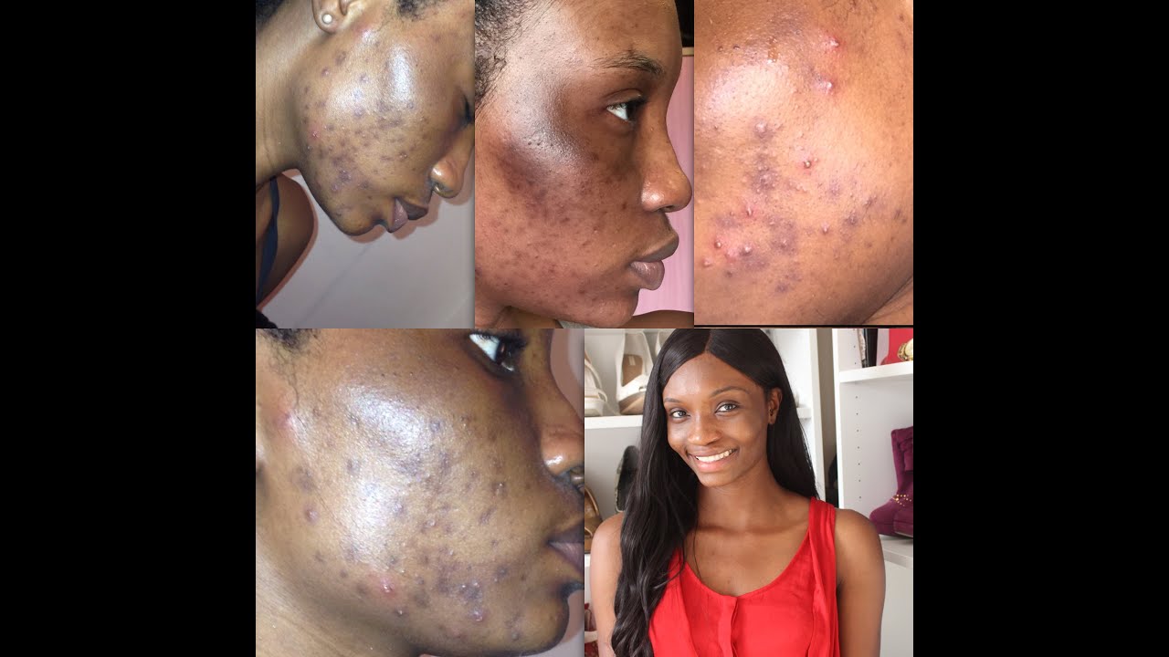 Natural Ways To Remove Scars Of Pimples Natural Ways To Remove Scars Of Pimples