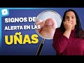 10 Cambios en tus Uñas que Podrían Indicar Problemas de Salud