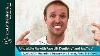 Underbite and Large Jaw Fix with Face Lift Dentistry®, 8-Days