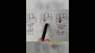 Famous angular bone defects |by Goldman and Cohen| periodontics Profile