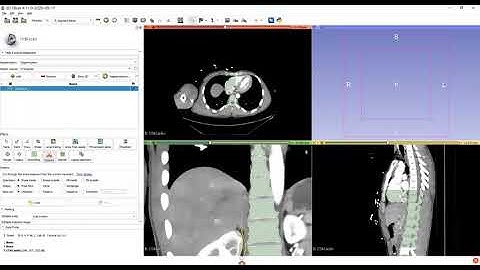 3D Slicer: How to segment vertebrae using thresholding and to export file to a 3D printer.