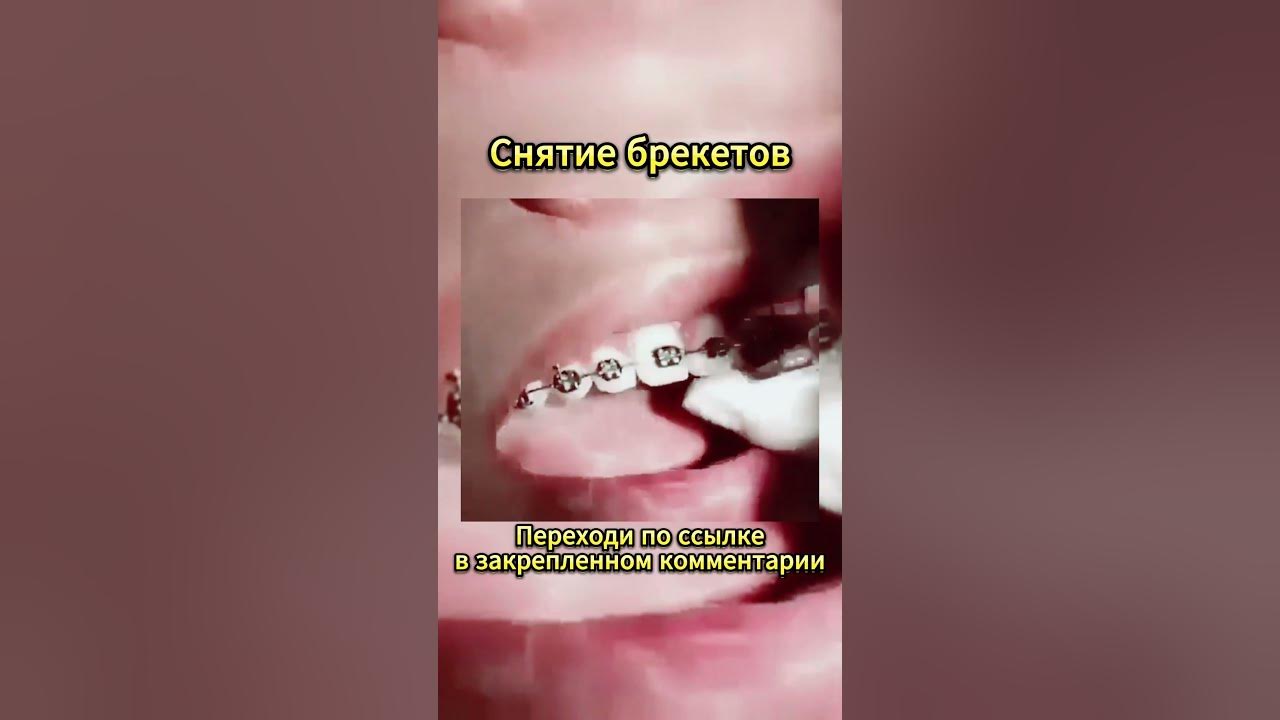 Снятие брекетов #стоматология #зубы #брекеты #отбеливаниезубов # ...