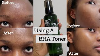 Latterlig National folketælling Rendezvous How I am improving my textured skin and overall complexion, Using Benton  Aloe BHA Skin Toner - YouTube
