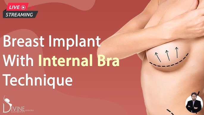 Breast Implant With Internal Bra Technique