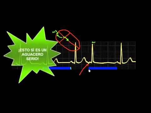 Vídeo: Extrasístole Supraventricular: Síntomas Y Tratamiento