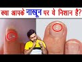 क्या आपके नाखून पे ये है ? नाखून पे ये सफ़ेद दाग क्यों होता है? Nails Spots Explained - AMF Ep 61