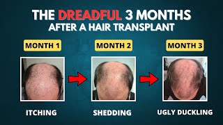 The DREADFUL First 3 Months after a Hair Transplant