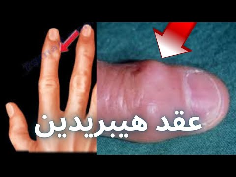النتوءات العظمية بأصابع اليد ما يجب أن تعرفه  