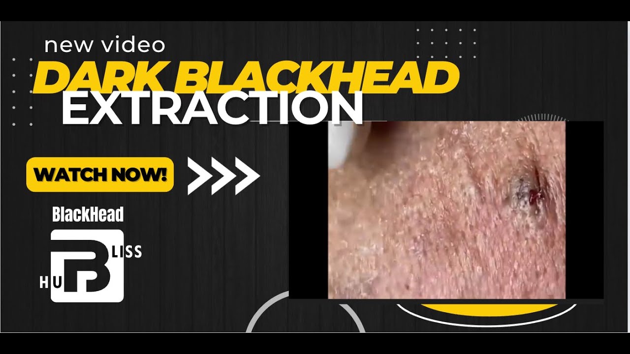 Some Blackheads Turns Dark/Black!!! Discover The Clever Science Behind ...