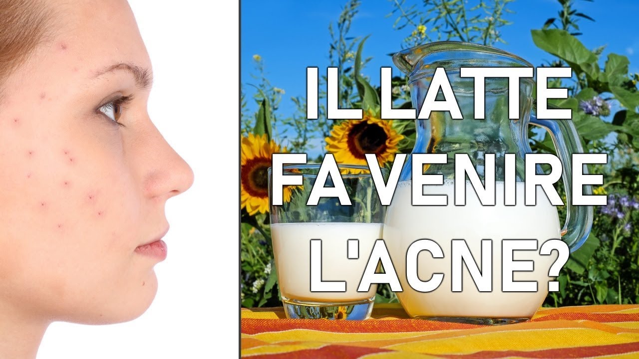 La Nutella Fa Venire I Brufoli