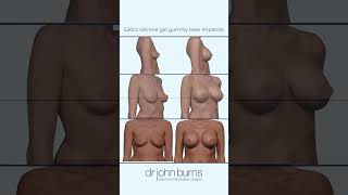 A to D Bup 520cc Breast Augmentation by Dr. John Burns A To C Cup Breast Implants Getting The Size Right Dr John Burns