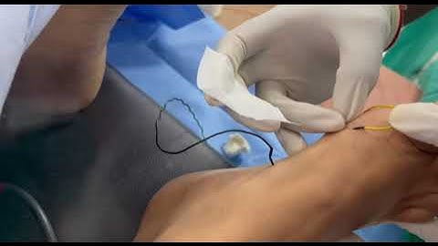 MEP & EMG Electrode Placement in Lower Limbs | Intraoperative Monitoring Demo