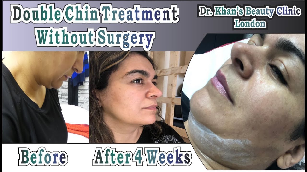 HOW TO GET RID OF DOUBLE CHIN WITHOUT SURGERY Dr.Khan's