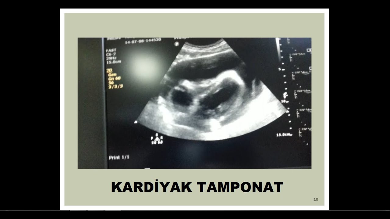 Kardiyak Tamponad