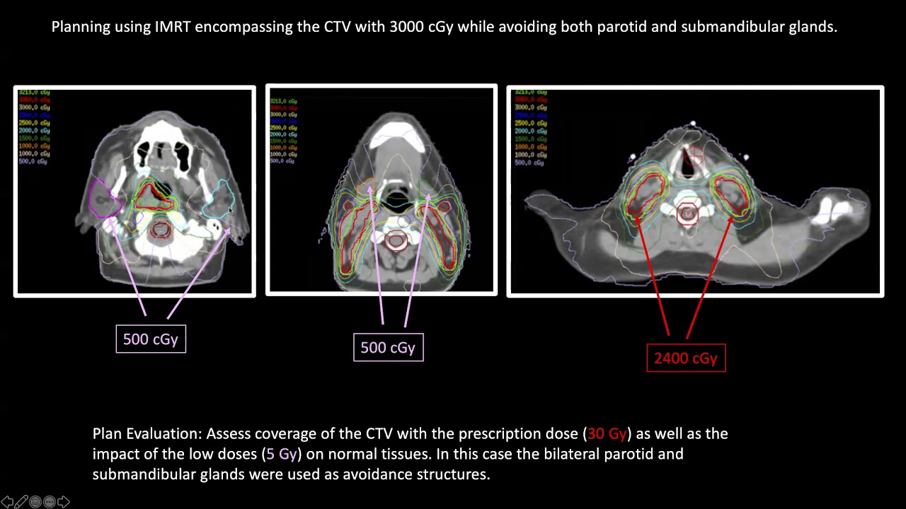 Dr. Bouthaina Dabaja: Radiation Therapy for Lymphoma of the Head-and-Neck