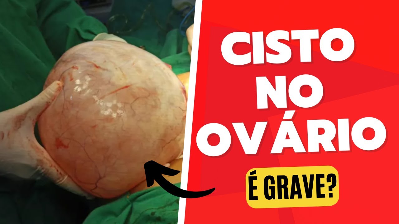Cisto no ov rio perigoso youtube