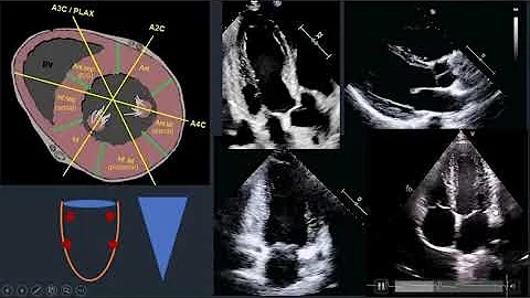 Wall Motion Abnormalities in Echocardiography