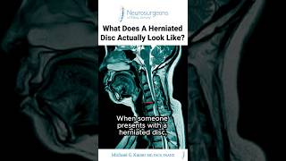 What Does a Herniated Disc Actually Look Like? - Dr. Michael Kaiser What Causes Cervical Stenosis Dr Michael Kaiser