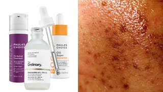 The Best Skincare For Hyperpigmentation