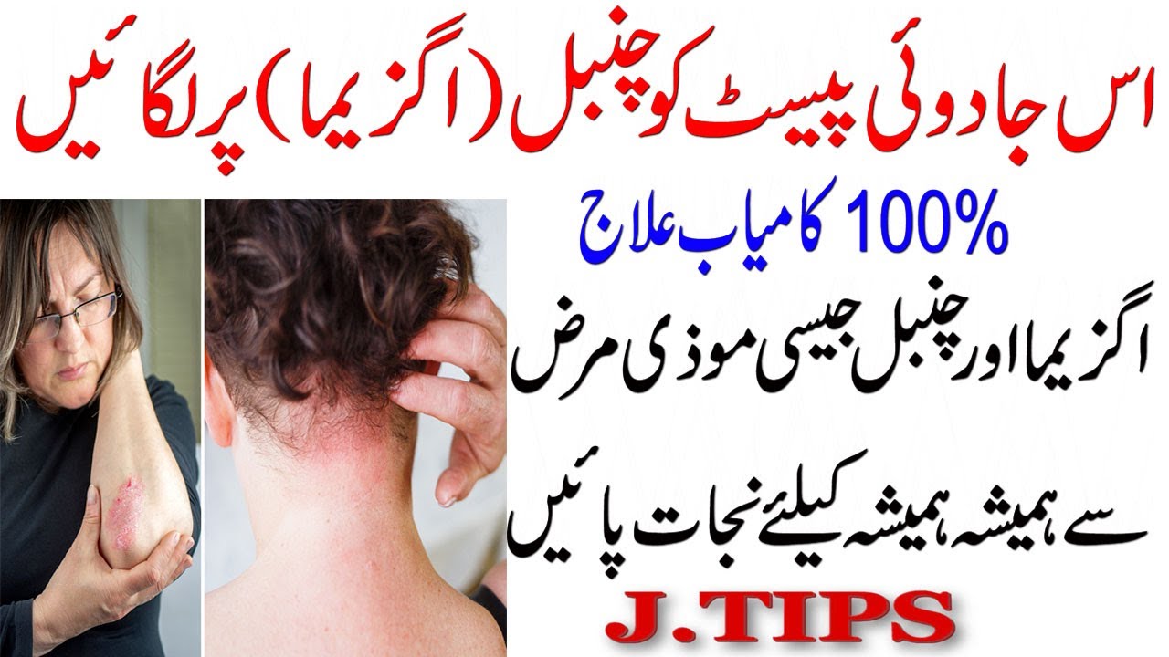 Top 6 Natural and Alternative Treatments for Eczema  How to Get Relief From Eczema  Health Tips