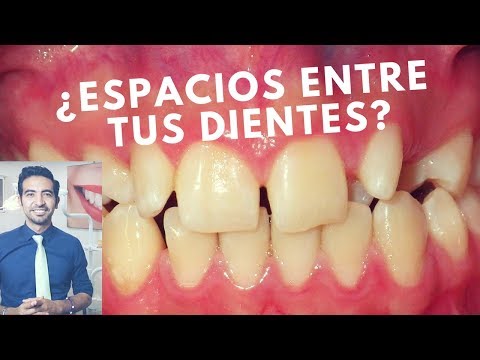 Cómo cerrar los espacios entre los dientes. Diastemas dentales