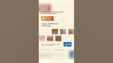 Monkeypox virus found in Pierce County wastewater