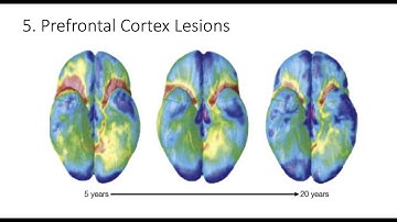 9.5. Prefrontal Cortex Lesions, Fundamentals of Cognitive Neuroscience Course, Session 9, Part 5