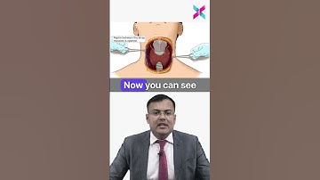 Thyroidectomy in 2 Minutes From Version X