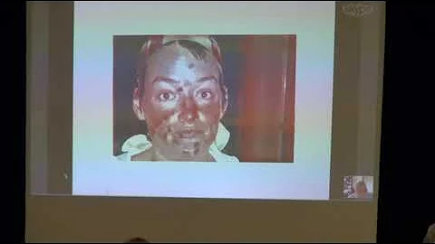 Canine Filamentous Dermatitis Associated with Borr...