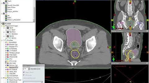 3 Contouring Optimization Structures for Prostate IMRT